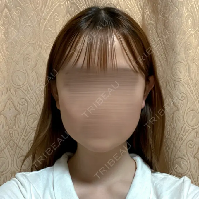 骨切り（あご） / 骨削り（エラ） / 骨削り（頬） セギム美容整形外科 AFTER メイン用