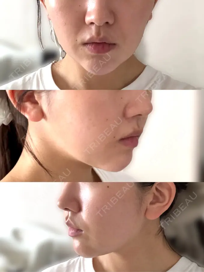 その他（肌） / ハイフ（顔） メディアージュクリニック 青山院 DAY 1 メイン用