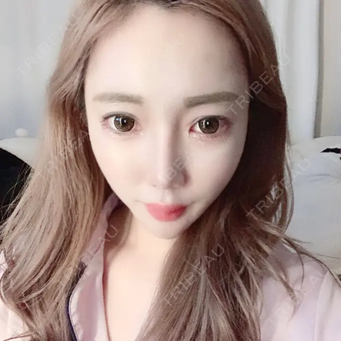 目頭切開 / 糸リフト / あごプロテーゼ / バッカルファット除去 / 目尻切開 / 軟骨移植 / 眉間プロテーゼ / ヒアルロン酸注入（涙袋） / その他（鼻） ミナ美容外科 AFTER メイン用