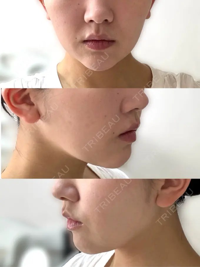 その他（肌） / ハイフ（顔） メディアージュクリニック 青山院 DAY 2 メイン用