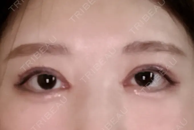 眼瞼下垂（非切開） SOL CLINIC DAY 56 メイン用