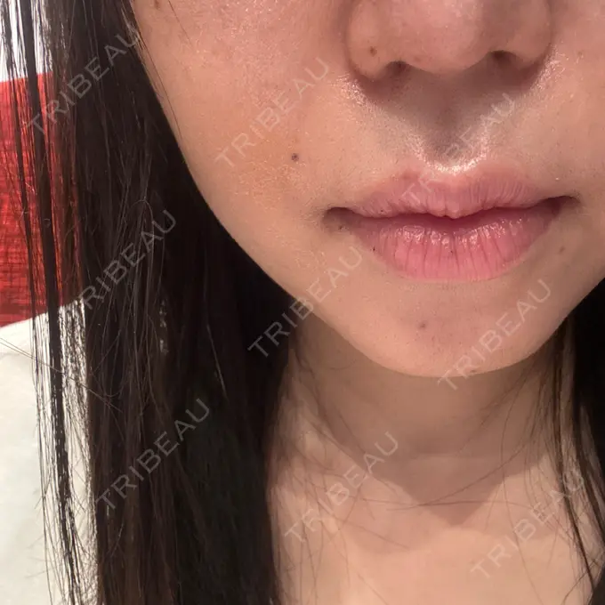 ハイフ（顔） YAYOI CLINIC AFTER メイン用