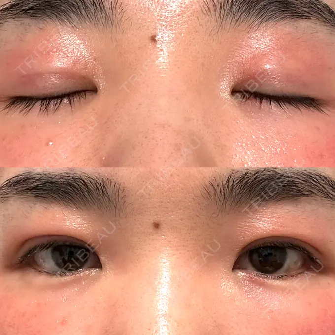 二重埋没 水の森美容クリニック 大阪梅田院 DAY 6 メイン用