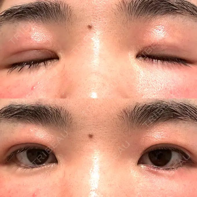 二重埋没 水の森美容クリニック 大阪梅田院 DAY 7 メイン用