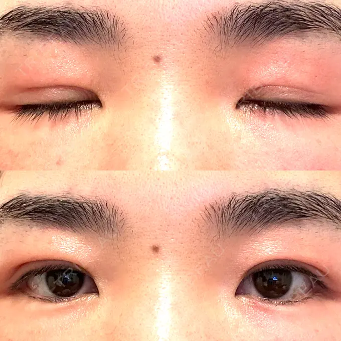 二重埋没 水の森美容クリニック 大阪梅田院 DAY 8 メイン用