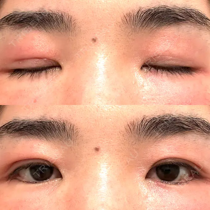 二重埋没 水の森美容クリニック 大阪梅田院 DAY 9 メイン用