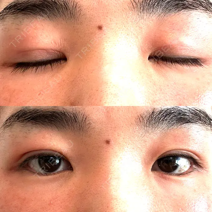 二重埋没 水の森美容クリニック 大阪梅田院 DAY 11 メイン用