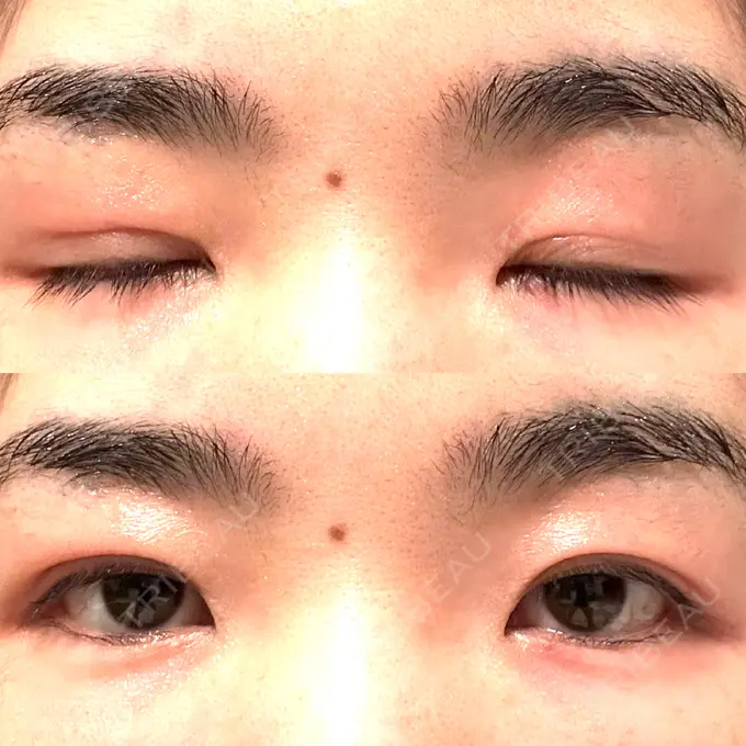 二重埋没 水の森美容クリニック 大阪梅田院 AFTER メイン用