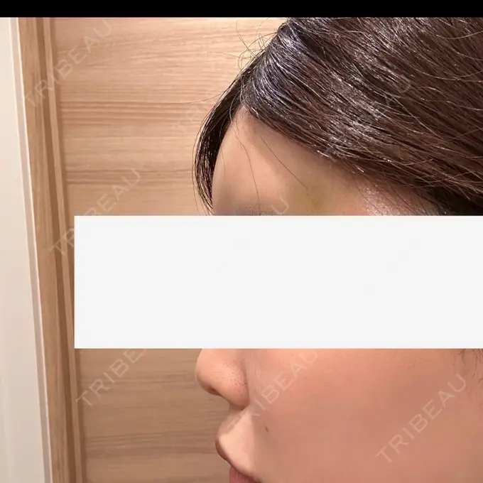 脂肪注入（額） / ヒアルロン酸溶解 ルーチェクリニック 銀座院 DAY 0 メイン用