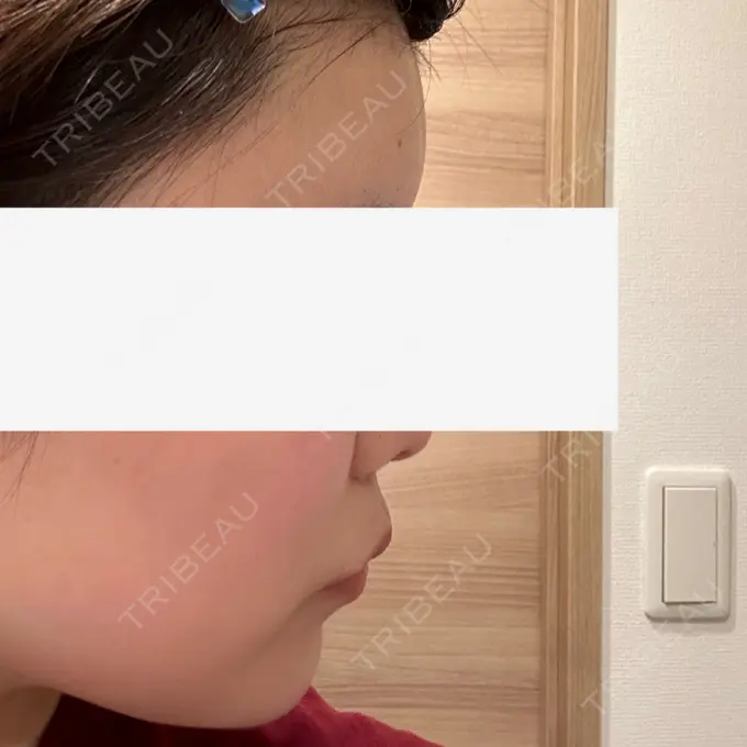 脂肪注入（額） / ヒアルロン酸溶解 ルーチェクリニック 銀座院 DAY 14 メイン用