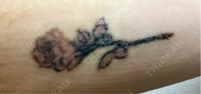 タトゥー除去 ルラ美容クリニック 福岡本院 DAY 12 メイン用