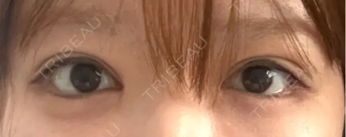 二重埋没 東京シンデレラ美容外科 大宮院 AFTER メイン用