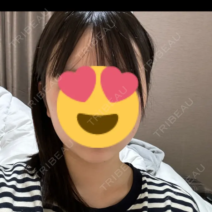 その他（肌） / ハイフ（顔） ゆきスキンクリニック 東池袋 AFTER メイン用