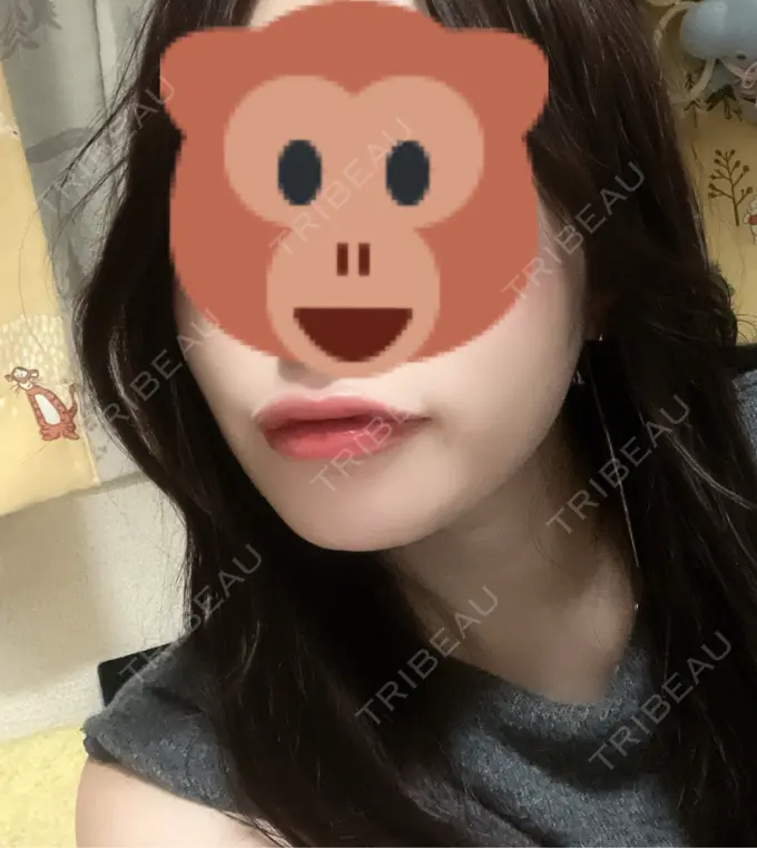 糸リフト / 脂肪吸引（顔） 東京ココセランクリニック AFTER メイン用