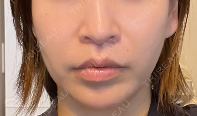 小鼻縮小（切開） / 人中短縮 Otus Clinic 【オータスクリニック】 DAY 81 メイン用