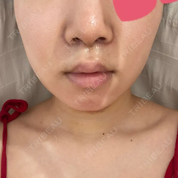 人中短縮 / 鼻翼挙上 / 鼻尖縮小 Otus Clinic 【オータスクリニック】 DAY 10 メイン用