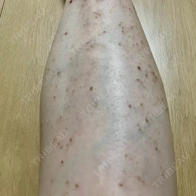 ほくろ・いぼ除去レーザー（肌） / シミ取りレーザー / ピコスポット Mavie Beauty Clinic （マヴィービューティークリニック） DAY 10 メイン用