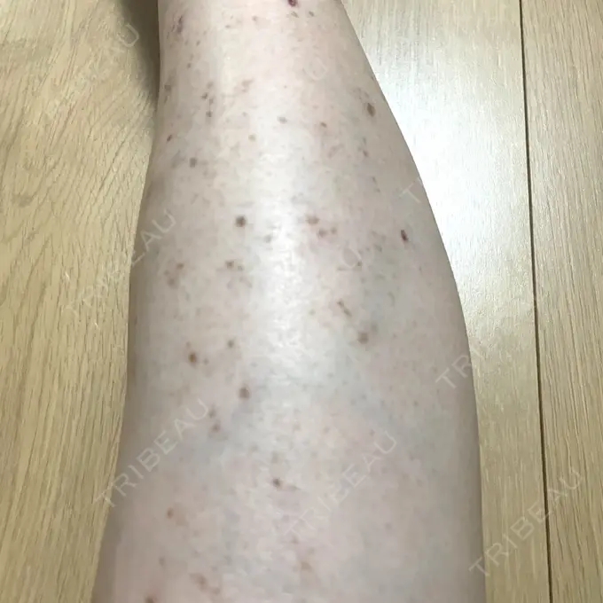 ほくろ・いぼ除去レーザー（肌） / シミ取りレーザー / ピコスポット Mavie Beauty Clinic （マヴィービューティークリニック） DAY 10 メイン用