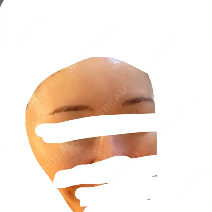 アートメイク（眉） 椿クリニック 名古屋院 DAY 57 メイン用