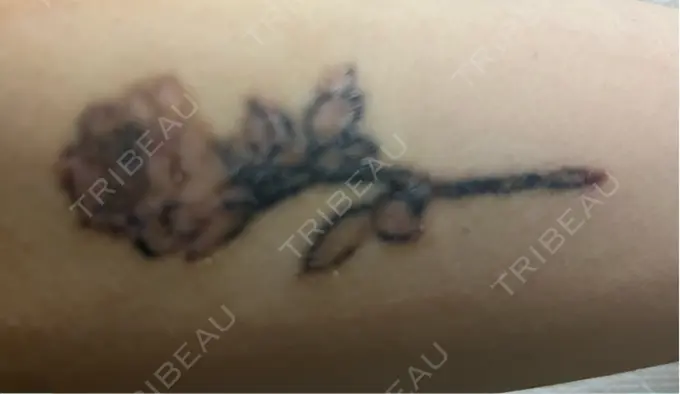 タトゥー除去 ルラ美容クリニック 福岡本院 DAY 14 メイン用