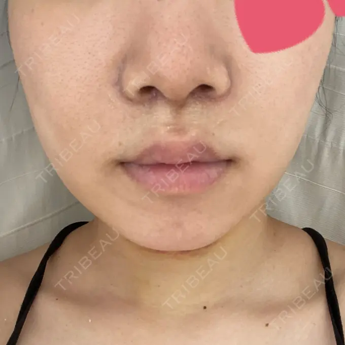 人中短縮 / 鼻翼挙上 / 鼻尖縮小 Otus Clinic 【オータスクリニック】 DAY 11 メイン用