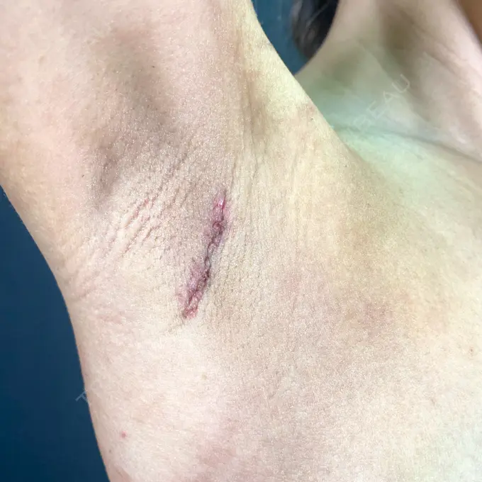 豊胸（シリコンバッグ） ジョウクリニック 大阪院 DAY 7 メイン用