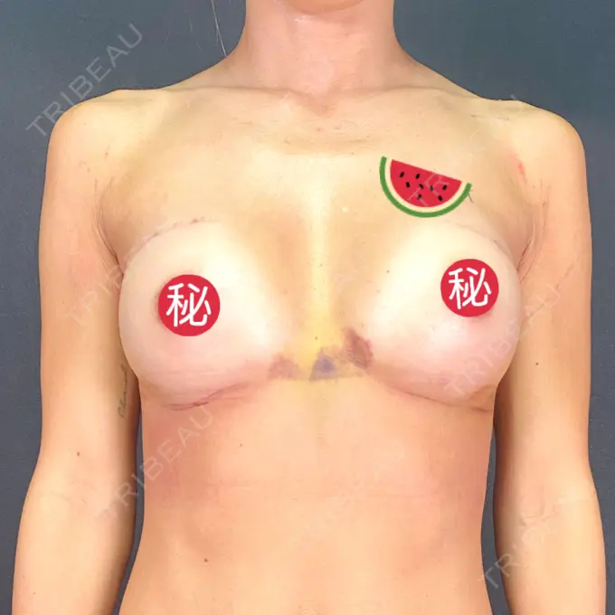 豊胸（シリコンバッグ） ジョウクリニック 大阪院 DAY 7 メイン用