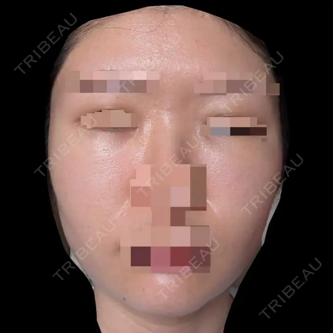 糸リフト / クマ治療 / 脂肪吸引（顔） / 脂肪注入（目の下） 東京ココセランクリニック DAY 18 メイン用