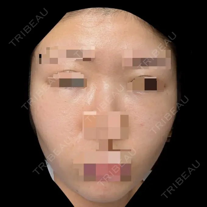 糸リフト / クマ治療 / 脂肪吸引（顔） / 脂肪注入（目の下） 東京ココセランクリニック DAY 21 メイン用