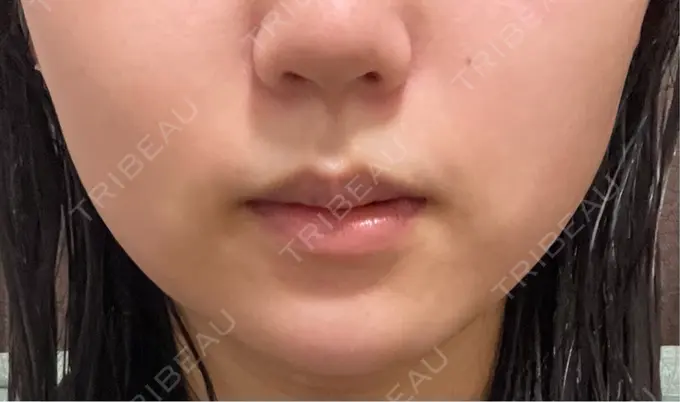 ボトックス（エラ・小顔） TCB東京中央美容外科 仙台駅前院 DAY 10 メイン用