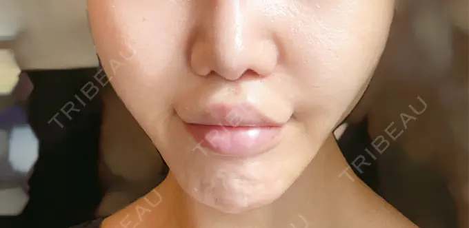 人中短縮 / 口角挙上 Otus Clinic 【オータスクリニック】 DAY 42 メイン用