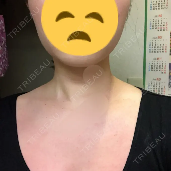 ボトックス（肩） リエンジャン整形外科 江南店 DAY 8 メイン用