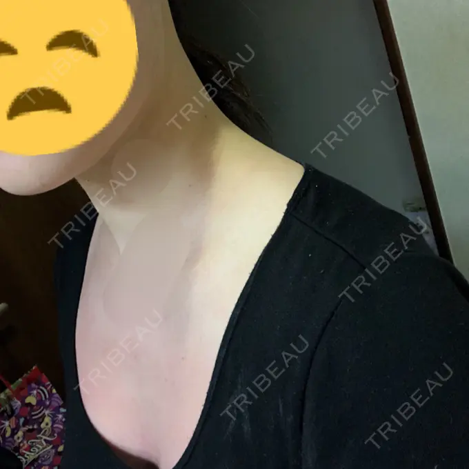 ボトックス（肩） リエンジャン整形外科 江南店 DAY 8 メイン用