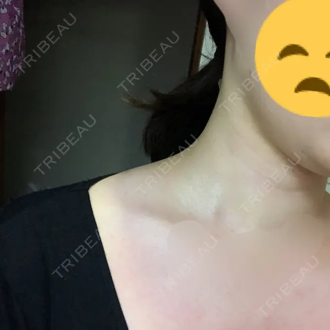 ボトックス（肩） リエンジャン整形外科 江南店 DAY 8 メイン用