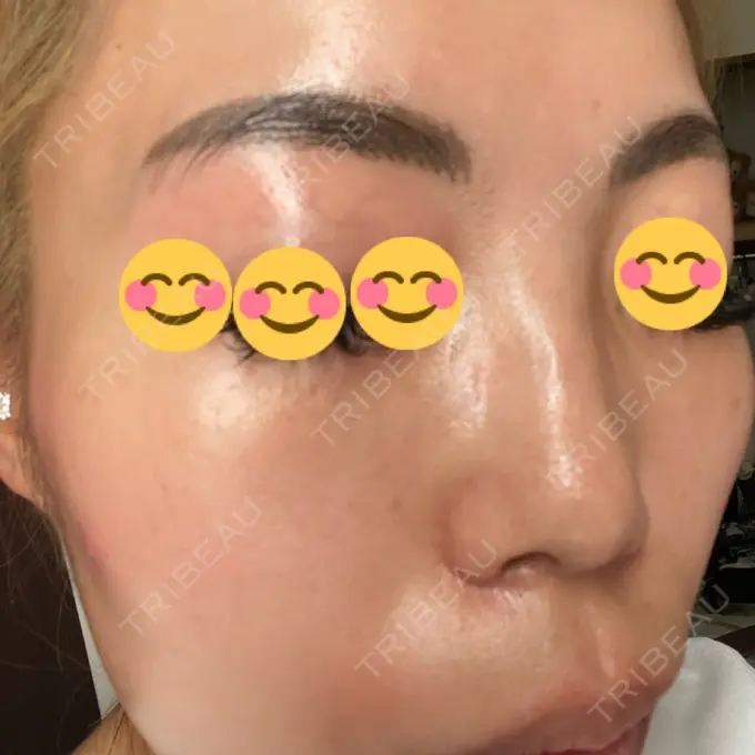 ピーリング（ニキビ・毛穴） / 美肌レーザー / シミ取りレーザー / 美白レーザー / 毛穴洗浄（ハイドラフェイシャルなど） / ピコレーザートーニング（美白・肝斑） / レーザートーニング（美白・肝斑） / ピーリング（ハリ・ツヤ） LE CLINIC DAY 4 メイン用