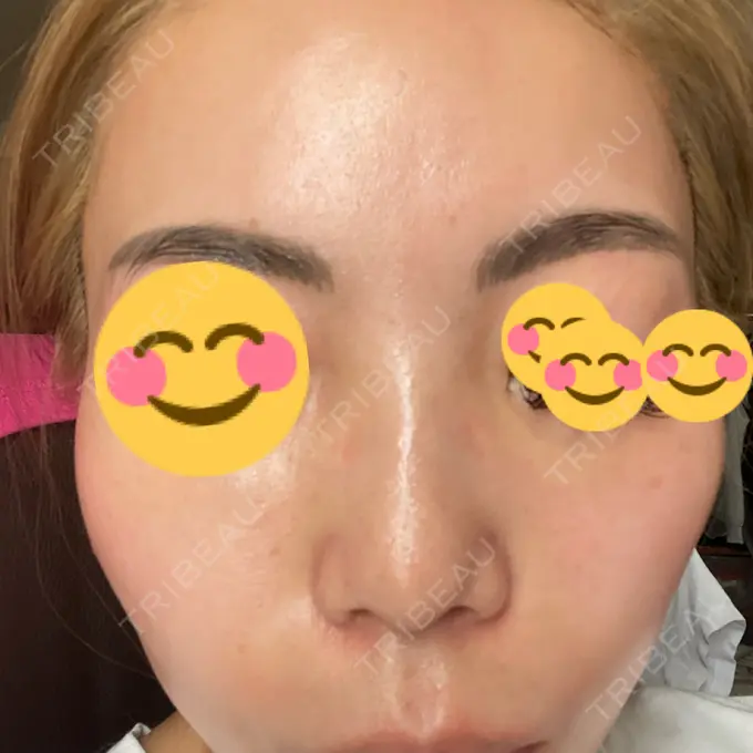 ピーリング（ニキビ・毛穴） / 美肌レーザー / シミ取りレーザー / 美白レーザー / 毛穴洗浄（ハイドラフェイシャルなど） / ピコレーザートーニング（美白・肝斑） / レーザートーニング（美白・肝斑） / ピーリング（ハリ・ツヤ） LE CLINIC DAY 5 メイン用