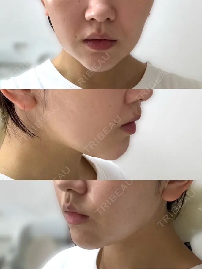 その他（肌） / ハイフ（顔） メディアージュクリニック 青山院 DAY 3 メイン用