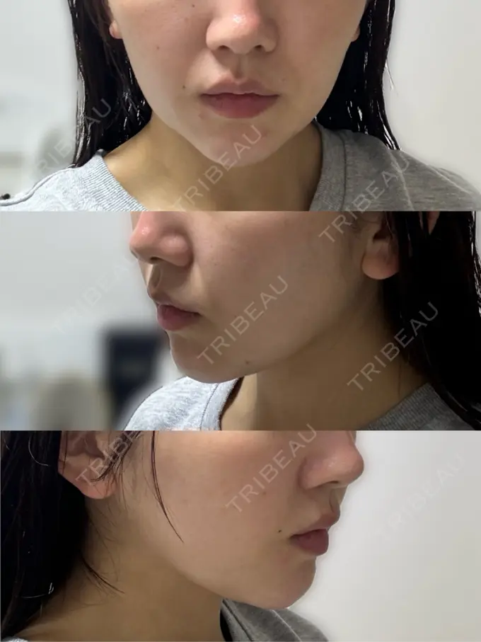 その他（肌） / ハイフ（顔） メディアージュクリニック 青山院 AFTER メイン用