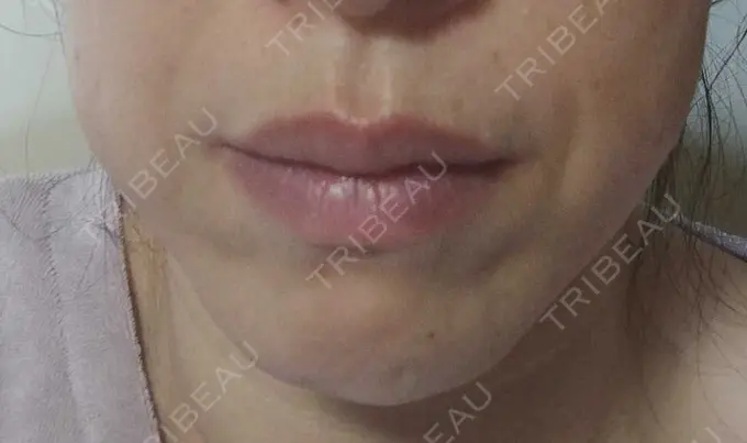 ボトックス（エラ・小顔） TCB東京中央美容外科 金山院 DAY 52 メイン用