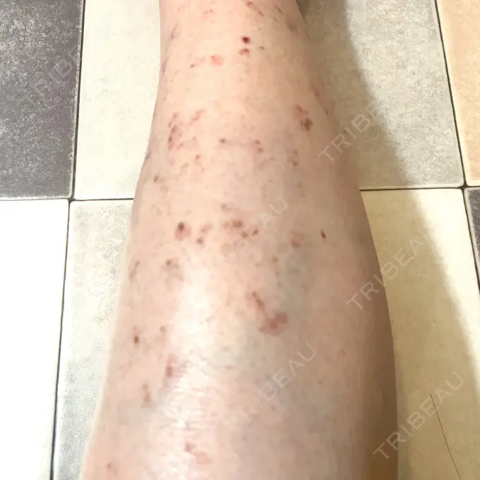 ほくろ・いぼ除去レーザー（肌） / シミ取りレーザー / ピコスポット Mavie Beauty Clinic （マヴィービューティークリニック） DAY 14 メイン用