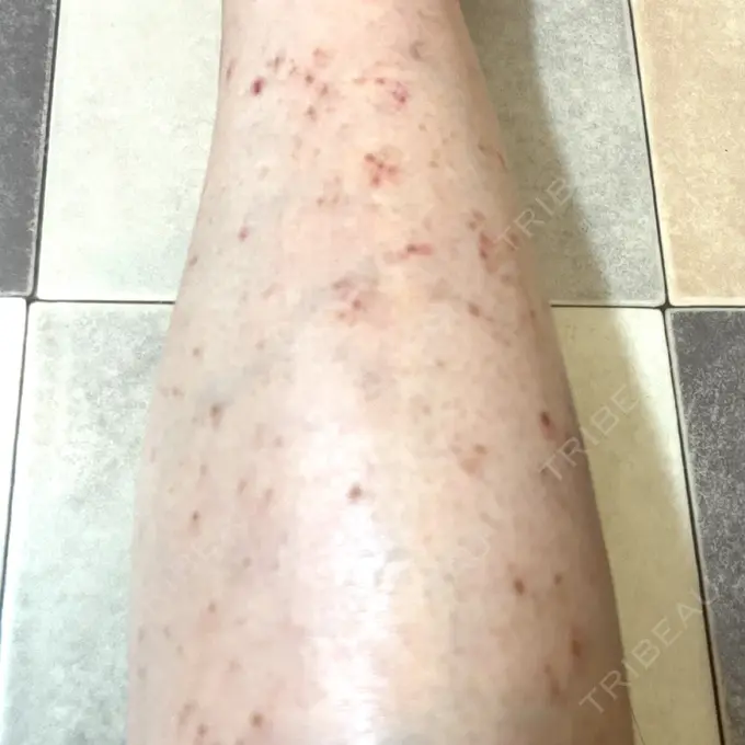 ほくろ・いぼ除去レーザー（肌） / シミ取りレーザー / ピコスポット Mavie Beauty Clinic （マヴィービューティークリニック） DAY 14 メイン用