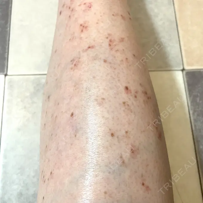 ほくろ・いぼ除去レーザー（肌） / シミ取りレーザー / ピコスポット Mavie Beauty Clinic （マヴィービューティークリニック） DAY 14 メイン用