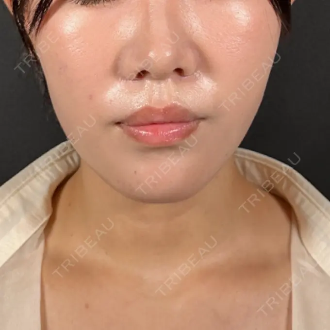 バッカルファット除去 / 脂肪吸引（顔） / メーラーファット除去 R Beauty CLINIC 名古屋院 DAY 138 メイン用