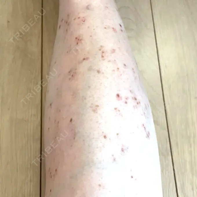 ほくろ・いぼ除去レーザー（肌） / シミ取りレーザー / ピコスポット Mavie Beauty Clinic （マヴィービューティークリニック） DAY 20 メイン用