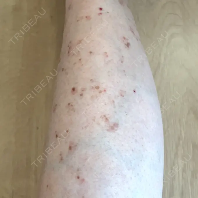 ほくろ・いぼ除去レーザー（肌） / シミ取りレーザー / ピコスポット Mavie Beauty Clinic （マヴィービューティークリニック） DAY 20 メイン用