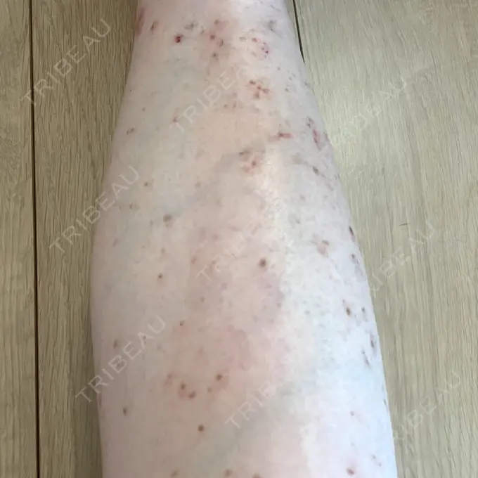 ほくろ・いぼ除去レーザー（肌） / シミ取りレーザー / ピコスポット Mavie Beauty Clinic （マヴィービューティークリニック） DAY 20 メイン用