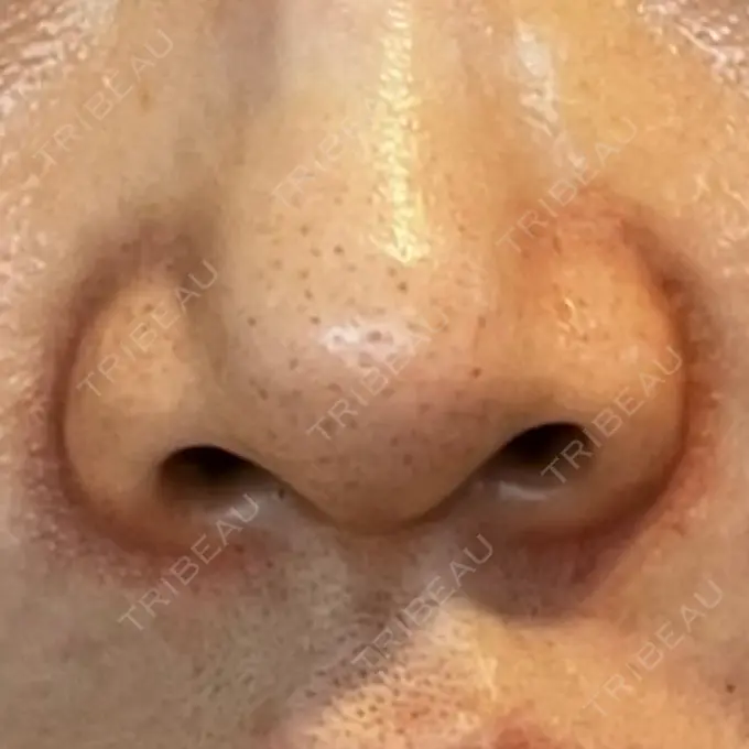 その他（鼻） LE CLINIC DAY 14 メイン用