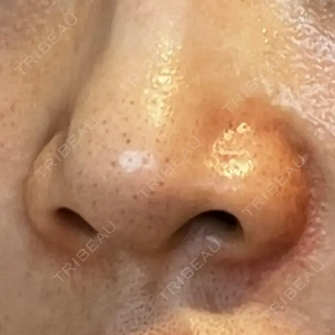 その他（鼻） LE CLINIC DAY 14 メイン用