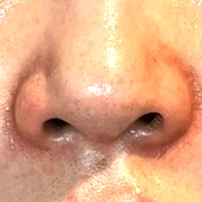 その他（鼻） LE CLINIC DAY 28 メイン用