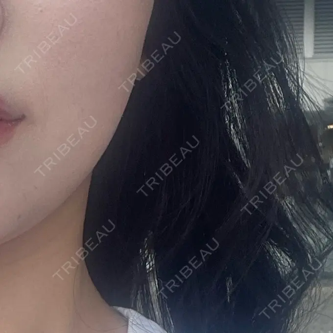 ボトックス（エラ・小顔） TCB東京中央美容外科 自由が丘院 DAY 2 メイン用